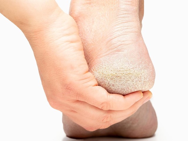Trucos y tratamientos para evitar las grietas y las durezas en tus pies